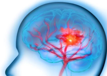 Agregar medicamentos que fluidifican la sangre a los anticoagulantes no mejorará los resultados de los accidentes cerebrovasculares, según un estudio