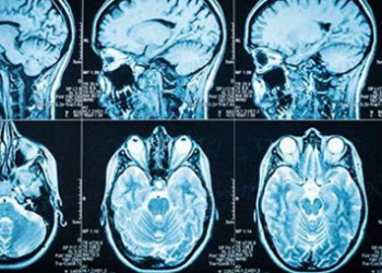 El hierro se acumula en el cerebro después de las conmociones cerebrales