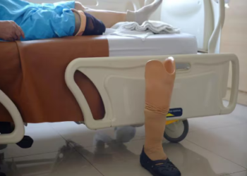 Descubren el primer tratamiento para una enfermedad rara que puede llevar a la amputación