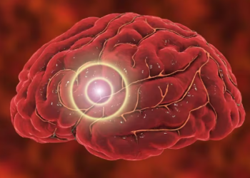 El accidente cerebrovascular mata a 7 millones de personas en todo el mundo cada año, y las muertes van en aumento