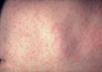 Aumento de casos de sarampión en América: ¿Los adultos deben recibir una dosis de refuerzo?